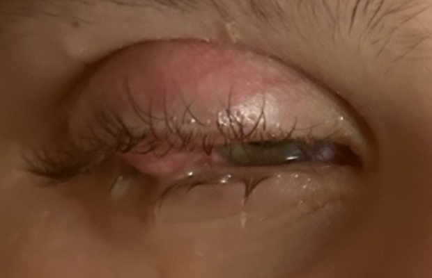Ligneous conjunctivitis accompanied by swelling