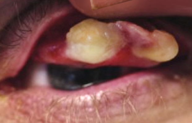 Ligneous conjunctivitis caused by congenital plasminogen deficiency type 1, manifesting as an eye lesion, prior to treatment