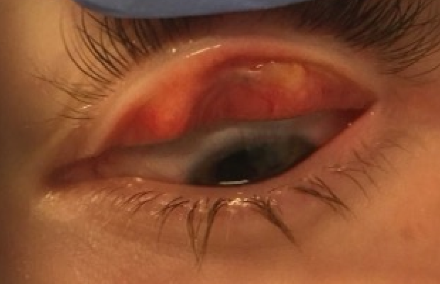 Ligneous conjunctivitis manifesting as a lesion under the upper eyelid