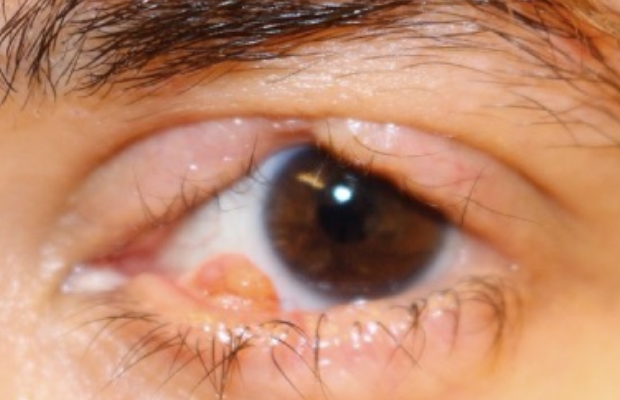 Ligneous conjunctivitis manifesting as a wart-like growth in the lower eyelid, accompanied by upper eyelid swelling