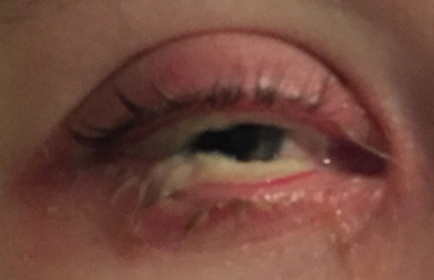 Ligneous conjunctivitis manifesting as a yellow discharge in the lower eyelid