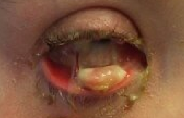 Ligneous conjunctivitis manifesting as large white mass under eyelid