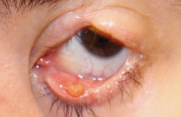 Ligneous conjunctivitis manifesting as lesions and swelling