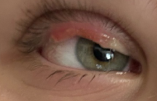 Ligneous conjunctivitis manifesting as upper eyelid swelling