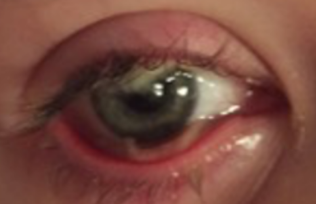 Ligneous conjunctivitis manifesting as watery, red eyes with lesions in lower eyelid