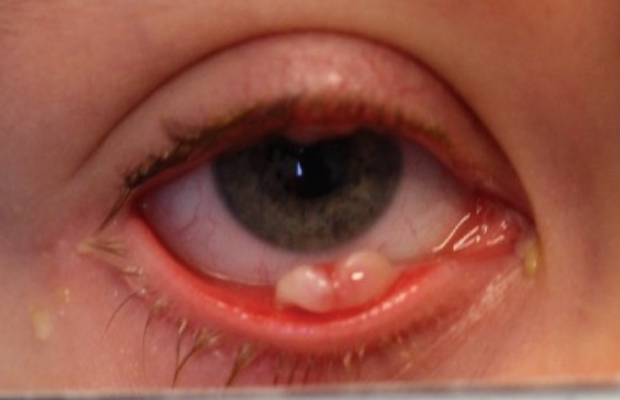 Ligneous conjunctivitis manifesting as white lesions in lower eyelid