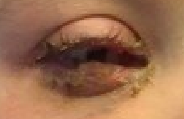 Ligneous conjunctivitis manifesting as wood-like growth under eye