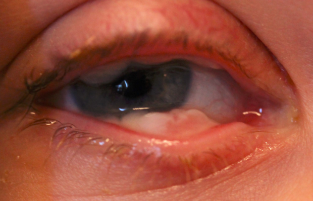 Ligneous conjunctivitis with lesion similar in appearance to conjunctival papilloma