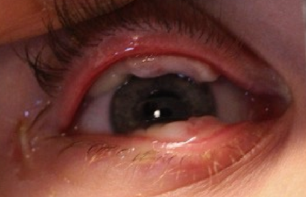 Ligneous conjunctivitis with lesions behind the upper and lower eyelids