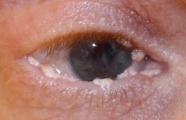 Ligneous conjunctivitis with multiple white, cauliflower-like lesions in upper and lower eyelids