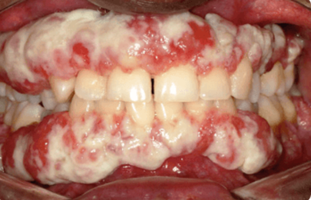 Ligneous gingivitis caused by congenital plasminogen deficiency type 1, manifesting as gum lesions