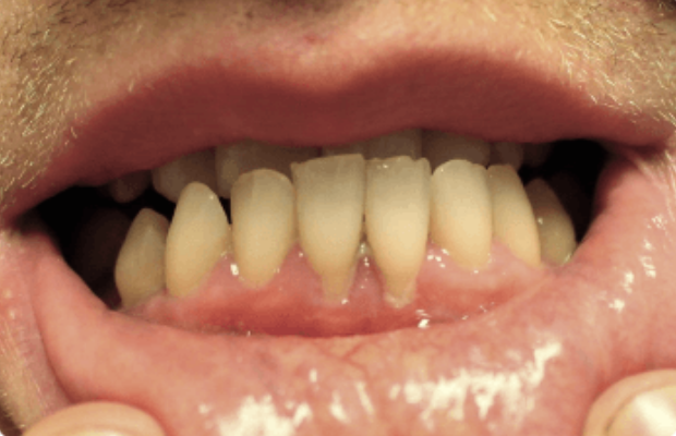 Ligneous gingivitis (periodontitis) with gingival enlargement