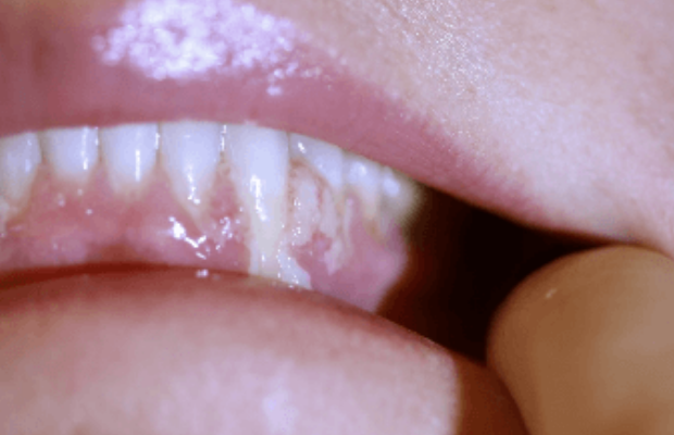 Ligneous gingivitis with gum swelling and lesions