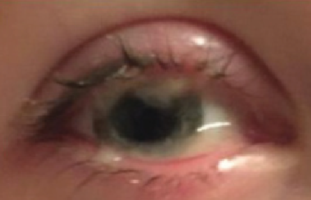 Pseudomembranous conjunctivitis caused by plasminogen deficiency type 1, with a watery and stringy appearance