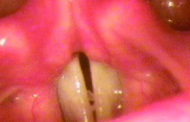 Respiratory tract lesions in plasminogen deficiency type 1 patient