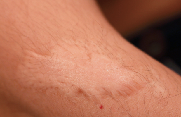 Skin lesions on arm