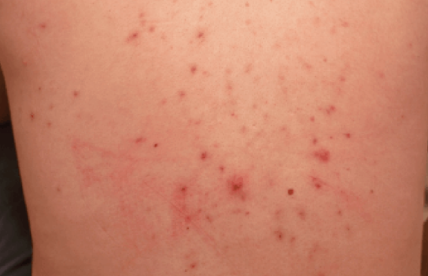 Skin lesions on back