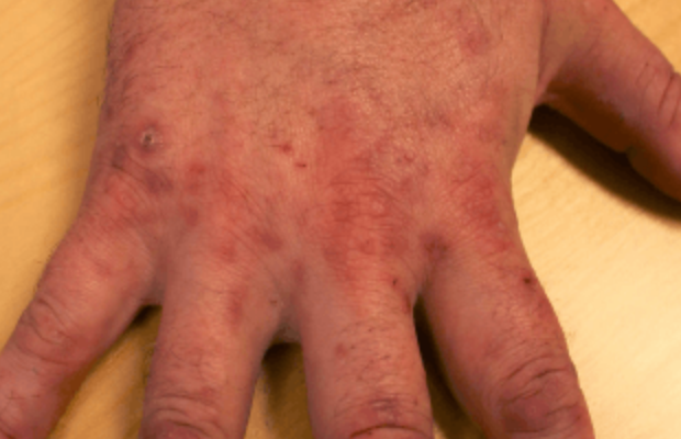 Skin lesions on hand