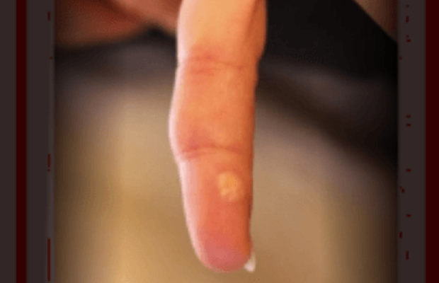 Skin lesions on thumb