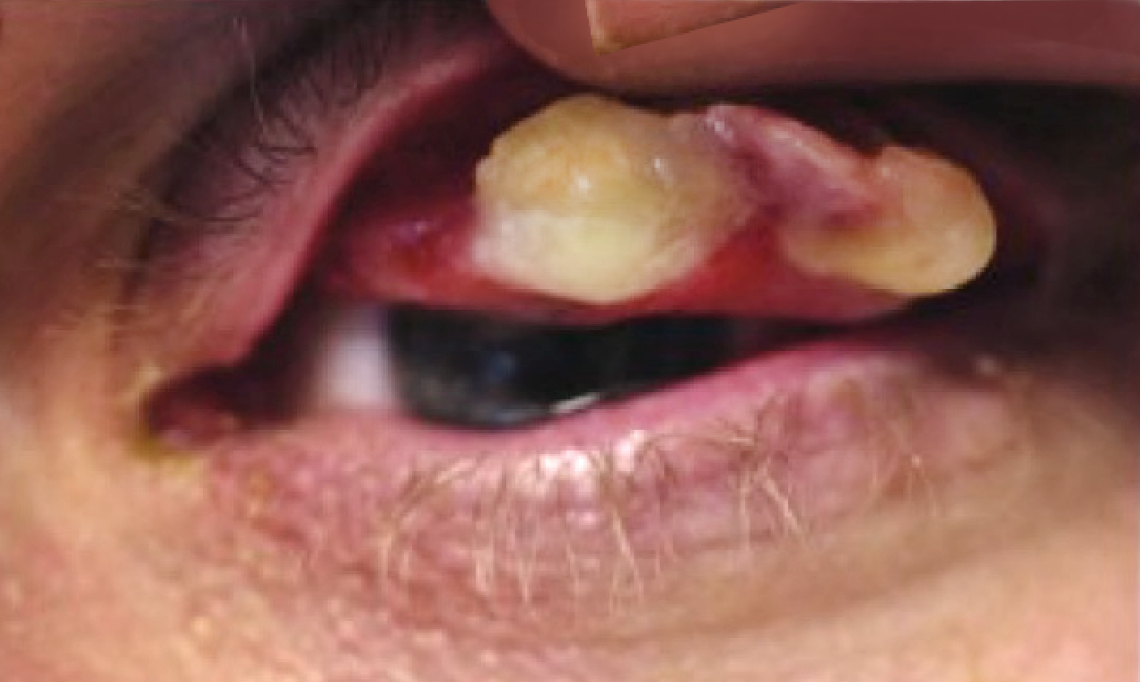 Ligneous conjunctivitis caused by congenital plasminogen deficiency type 1, manifesting as an eye lesion, prior to treatment