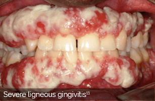 Ligneous gingivitis caused by congenital plasminogen deficiency type 1, manifesting as gum lesions