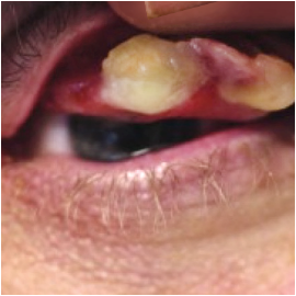 Ligneous conjunctivitis caused by congenital plasminogen deficiency type 1, manifesting as an eye lesion, prior to treatment