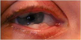 Ligneous conjunctivitis with lesion similar in appearance to conjunctival papilloma