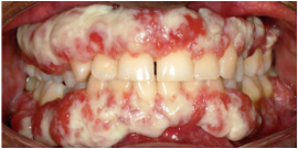 Ligneous gingivitis caused by congenital plasminogen deficiency type 1, manifesting as gum lesions