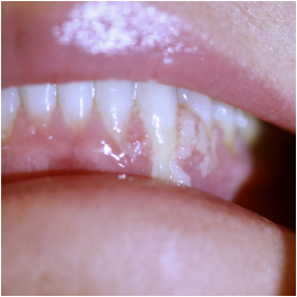 Ligneous gingivitis with gum swelling and lesions
