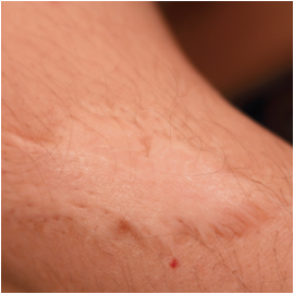 Skin lesions on arm